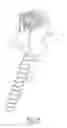 Fig. 02 - Bone anchor assemblies and methods with improved locking