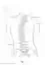 Fig. 02 - Subcutaneous implantable device for gradually aligning a spine and subcutaneous implantable device for gradually lengthening a bone