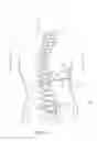 Fig. 19 - Subcutaneous implantable device for gradually aligning a spine and subcutaneous implantable device for gradually lengthening a bone