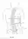 Fig. 21 - Subcutaneous implantable device for gradually aligning a spine and subcutaneous implantable device for gradually lengthening a bone