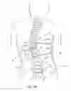 Fig. 22 - Subcutaneous implantable device for gradually aligning a spine and subcutaneous implantable device for gradually lengthening a bone