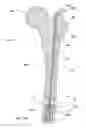Fig. 35 - Subcutaneous implantable device for gradually aligning a spine and subcutaneous implantable device for gradually lengthening a bone