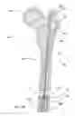 Fig. 36 - Subcutaneous implantable device for gradually aligning a spine and subcutaneous implantable device for gradually lengthening a bone