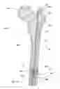 Fig. 37 - Subcutaneous implantable device for gradually aligning a spine and subcutaneous implantable device for gradually lengthening a bone