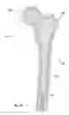 Fig. 38 - Subcutaneous implantable device for gradually aligning a spine and subcutaneous implantable device for gradually lengthening a bone