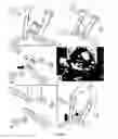 Fig. 02 - Techniques for reduction of basilar invagination and atlanto axial dislocation and surgical instruments thereof