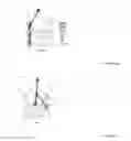 Fig. 12 - Techniques for reduction of basilar invagination and atlanto axial dislocation and surgical instruments thereof