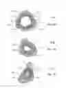 Fig. 10 - Bone stabilization device and method