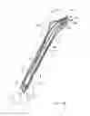 Fig. 20 - Bone stabilization device and method