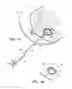 Fig. 05 - IMAGEABLE BIOPSY SITE MARKER