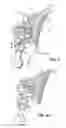 Fig. 03 - SELF-LIGATING ORTHODONTIC BRACKET