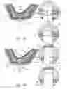 Fig. 10 - GUIDED SINUS LIFT