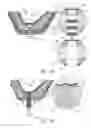 Fig. 11 - GUIDED SINUS LIFT