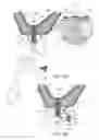 Fig. 12 - GUIDED SINUS LIFT