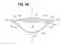 Fig. 04 - Accommodating intraocular lens