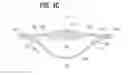 Fig. 05 - Accommodating intraocular lens