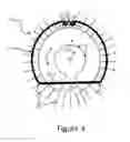 Fig. 05 - Exocapsular device and method for lens stabilization