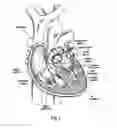 Fig. 02 - Methods of implanting a heart valve at an aortic annulus