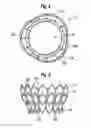 Fig. 04 - Methods of implanting a heart valve at an aortic annulus