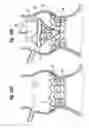 Fig. 09 - Methods of implanting a heart valve at an aortic annulus