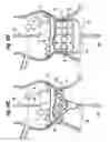 Fig. 10 - Methods of implanting a heart valve at an aortic annulus