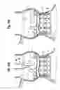 Fig. 11 - Methods of implanting a heart valve at an aortic annulus