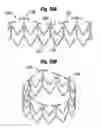 Fig. 17 - Methods of implanting a heart valve at an aortic annulus