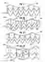Fig. 18 - Methods of implanting a heart valve at an aortic annulus