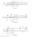 Fig. 04 - Low profile heart valve delivery system and method