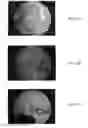 Fig. 05 - BONE GRAFT MATERIALS AND METHODS