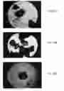 Fig. 09 - BONE GRAFT MATERIALS AND METHODS