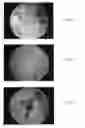 Fig. 10 - BONE GRAFT MATERIALS AND METHODS