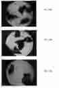 Fig. 11 - BONE GRAFT MATERIALS AND METHODS