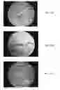 Fig. 13 - BONE GRAFT MATERIALS AND METHODS
