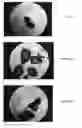 Fig. 14 - BONE GRAFT MATERIALS AND METHODS