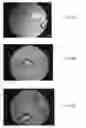 Fig. 15 - BONE GRAFT MATERIALS AND METHODS