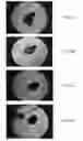 Fig. 16 - BONE GRAFT MATERIALS AND METHODS