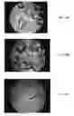 Fig. 17 - BONE GRAFT MATERIALS AND METHODS