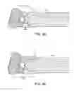 Fig. 10 - Systems and methods for joint stabilization