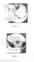 Fig. 16 - Sacroiliac fusion system