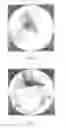 Fig. 17 - Sacroiliac fusion system