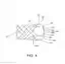 Fig. 03 - Integrated stent repositioning and retrieval loop