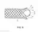 Fig. 05 - Integrated stent repositioning and retrieval loop
