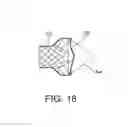 Fig. 12 - Integrated stent repositioning and retrieval loop