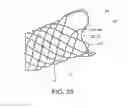 Fig. 17 - Integrated stent repositioning and retrieval loop
