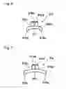 Fig. 07 - Ingrown nail correcting device