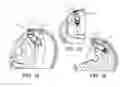 Fig. 13 - Expandable drug delivery devices and methods of use