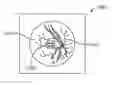 Fig. 01 - Grid pattern laser treatment and methods