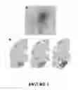 Fig. 02 - Method for Preventing and/or Treating Chronic Traumatic Encephalopathy - IV