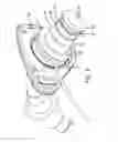 Fig. 03 - Compressible cannula connector with release grip